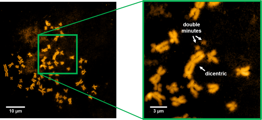 AFM topography of metaphase chromosomes isolated from HeLa cells after bleomycin treatment (c = 50 μM) and zoomed area of occurring chromosomal aberrations (double minutes and dicentric).
